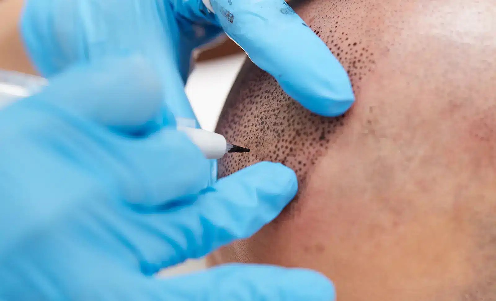 scalp micropigmentation for hair loss