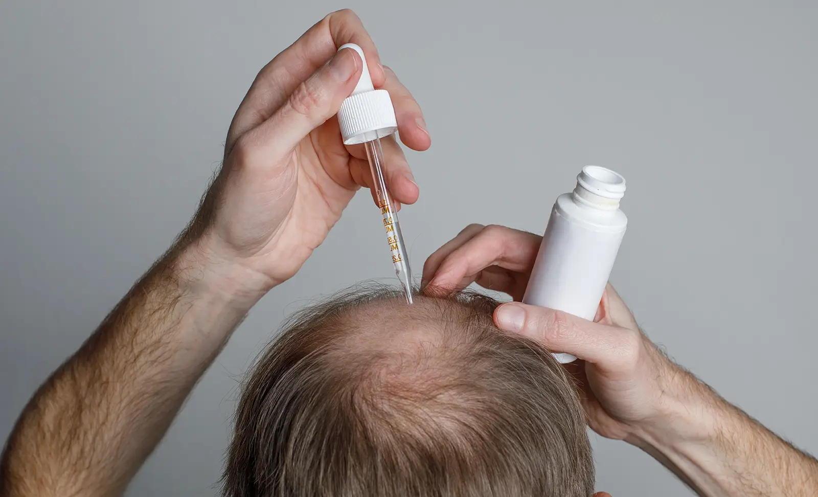 man applying minoxidil with a dropper onto balding crown