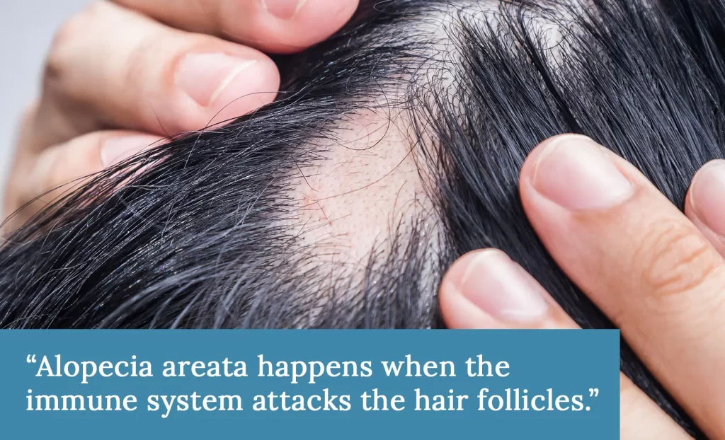 Alopecia Areata hair loss