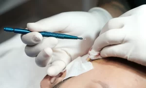 FUE hair transplant