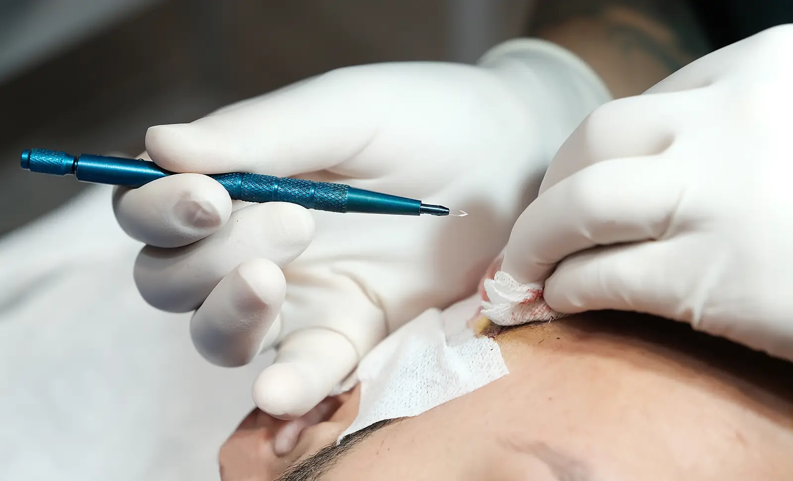 FUE hair transplant
