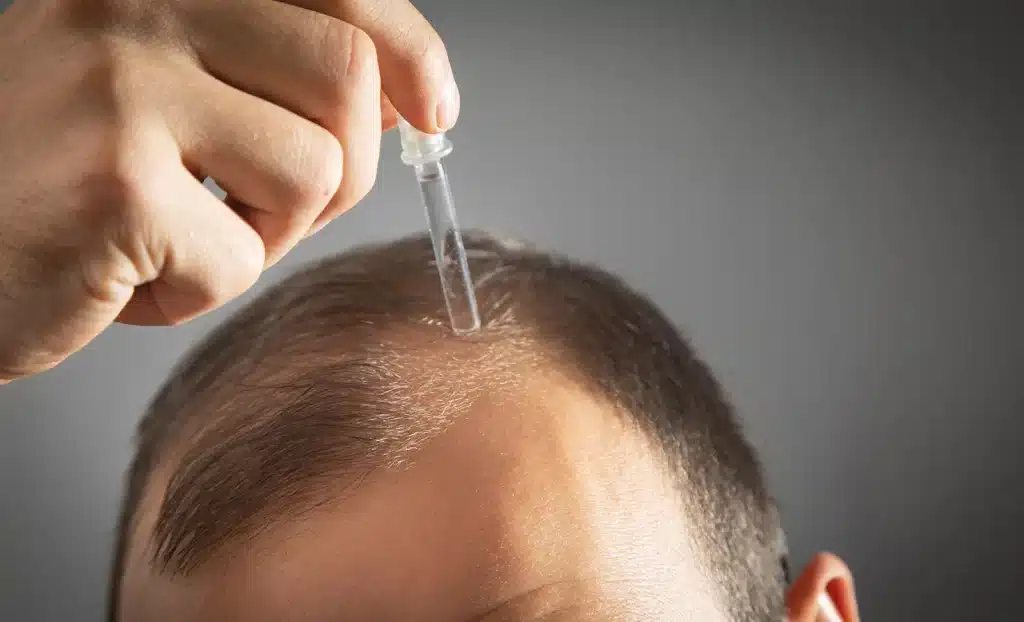 Nanoxidil or Minoxidil for hair loss