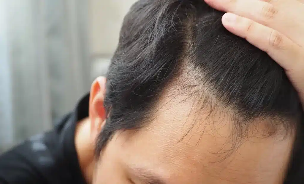 Androgenetic Alopecia in men