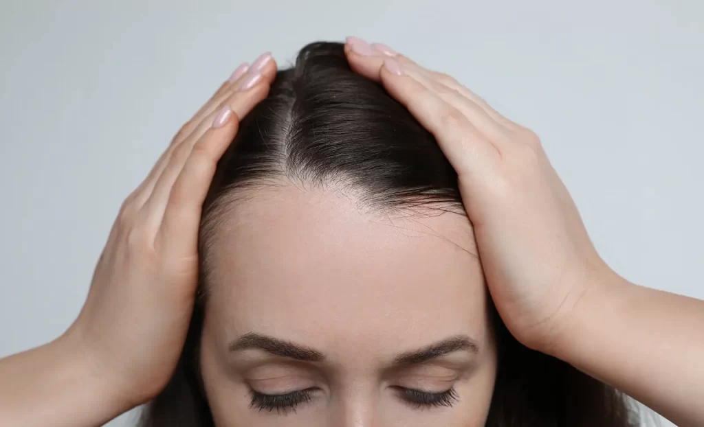 Telogen Effluvium hair loss