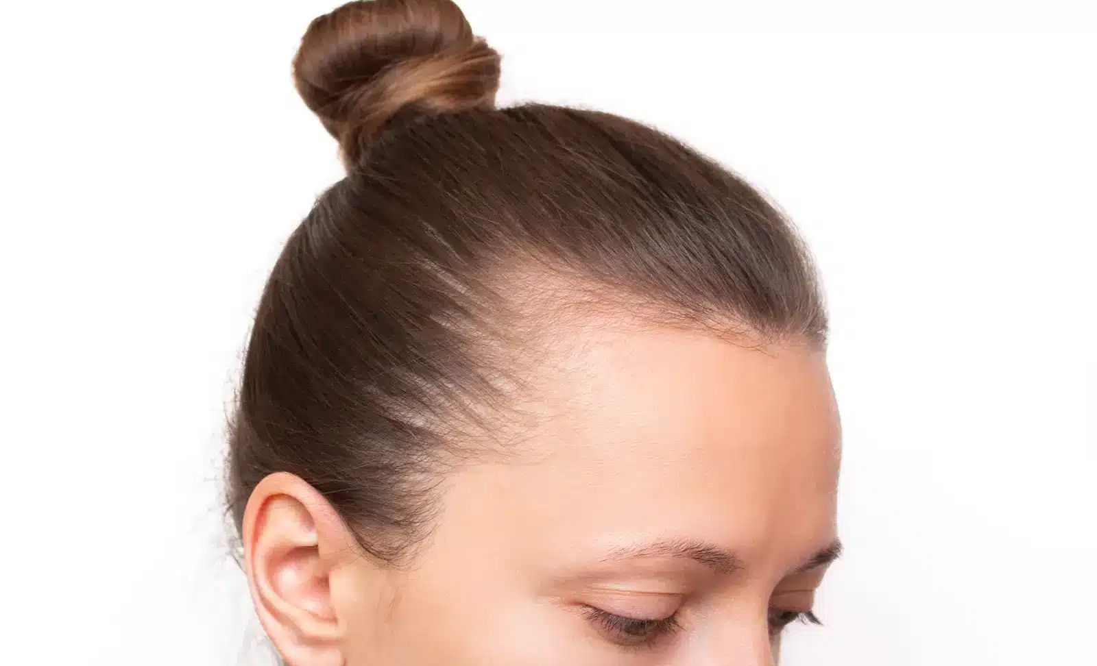 Thinning hair women