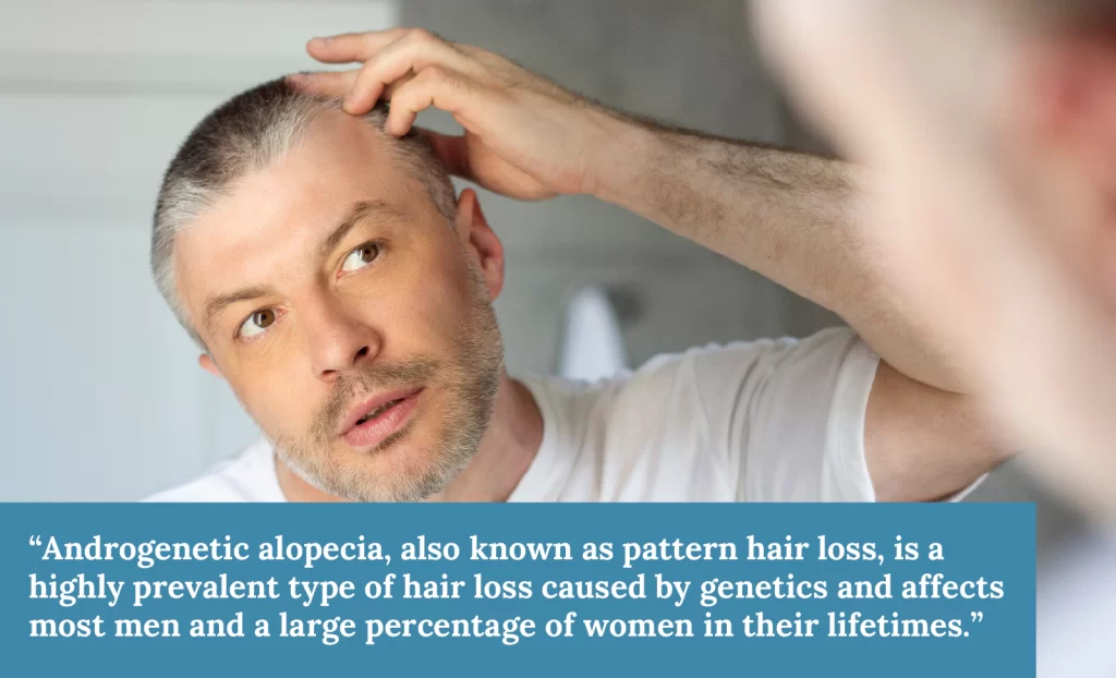 Androgenetic Alopecia and FUE 