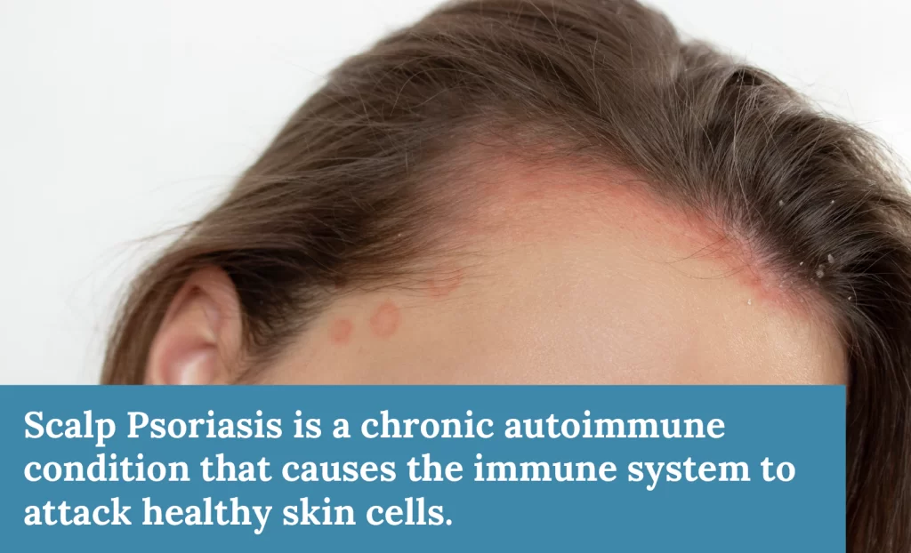 What is scalp psoriasis