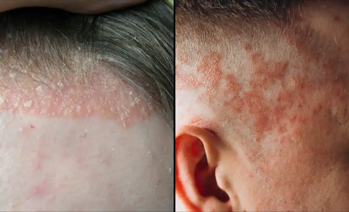 scalp psoriasis