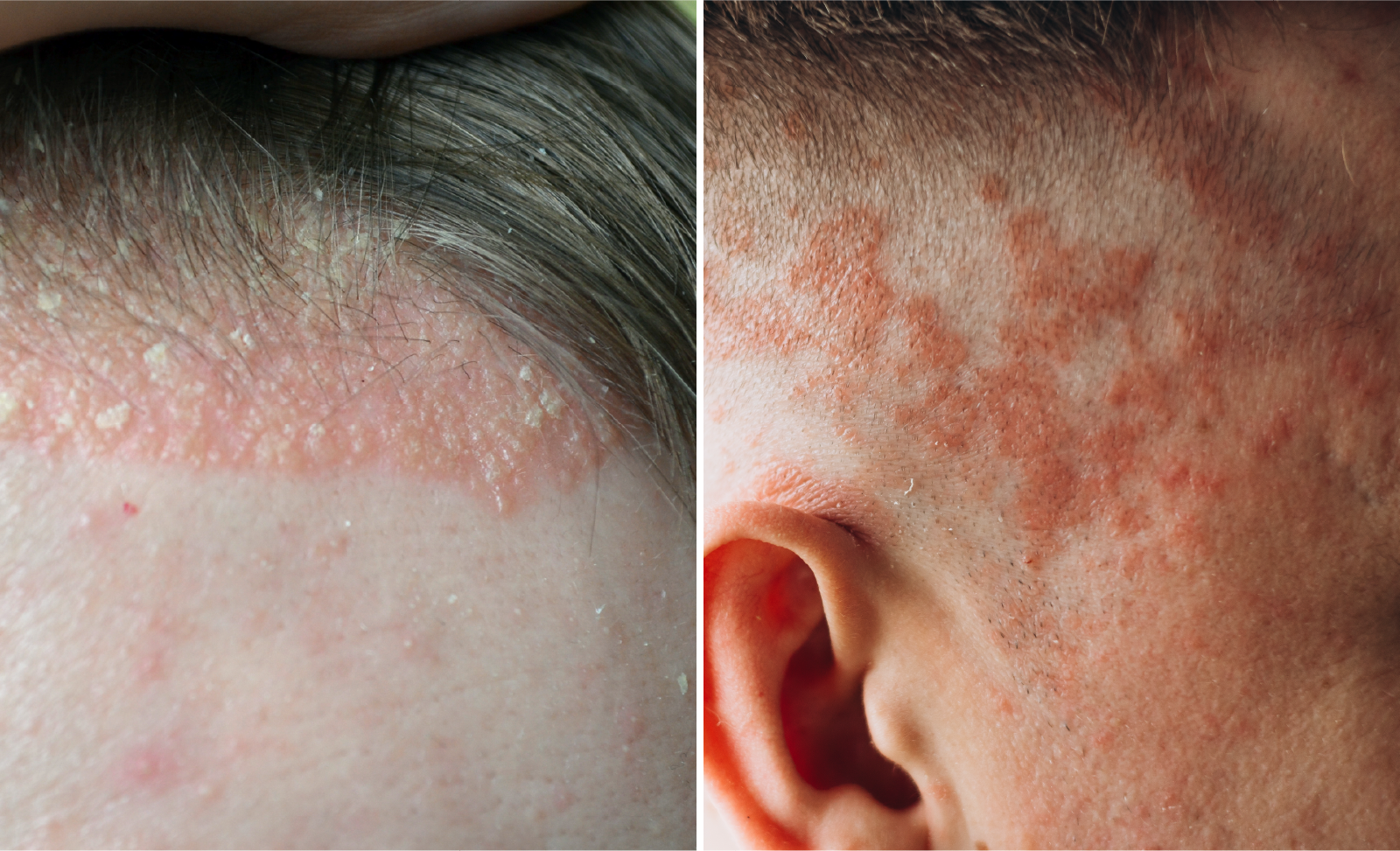 scalp psoriasis