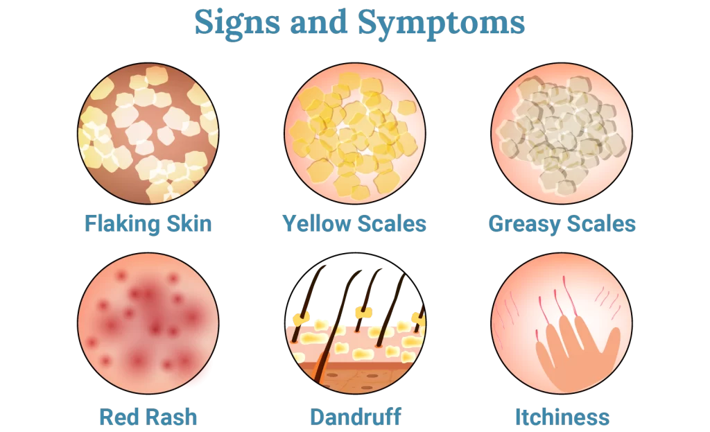 seborrheic dermatitis symptoms 