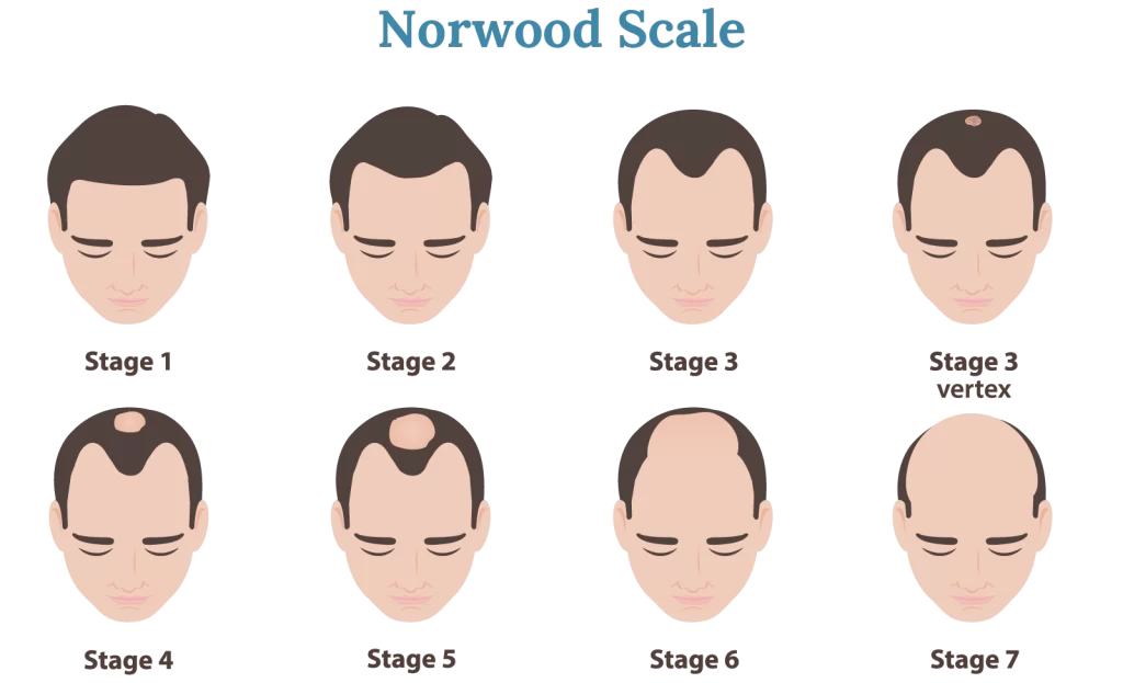 The Norwood scale harley street hair clinic 