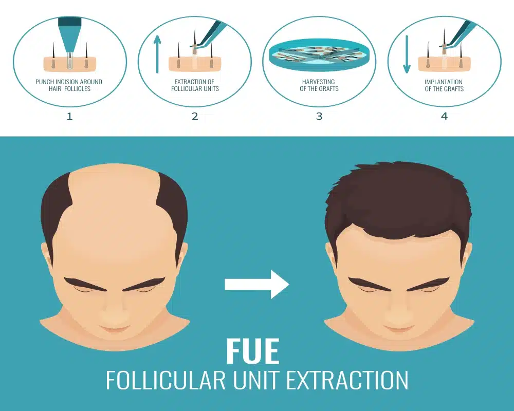 How FUE works 