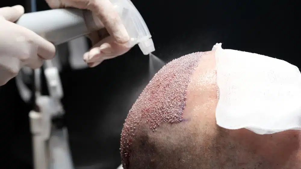 FUE Hair transplant