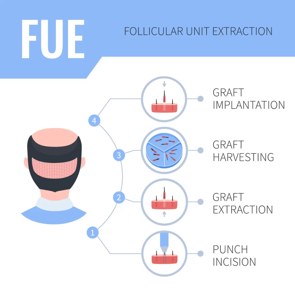 How does FUE work 