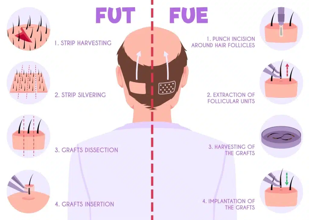 FUE vs FUT hair transplant