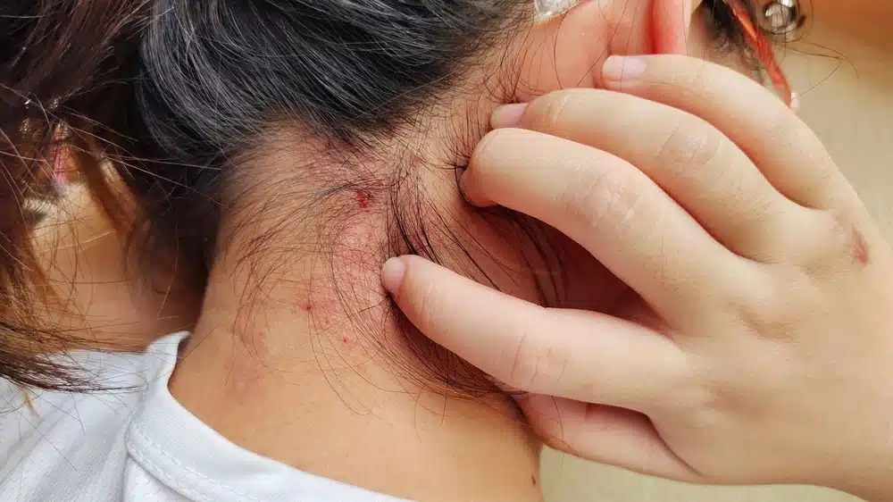 Follicular Eczema