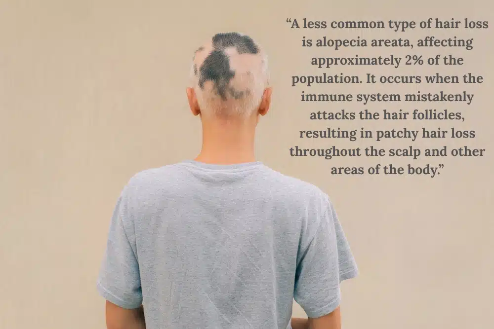 Alopecia Areata hair loss 