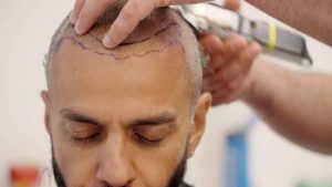 juggy D getting his head shaved for a hair transplant procedure