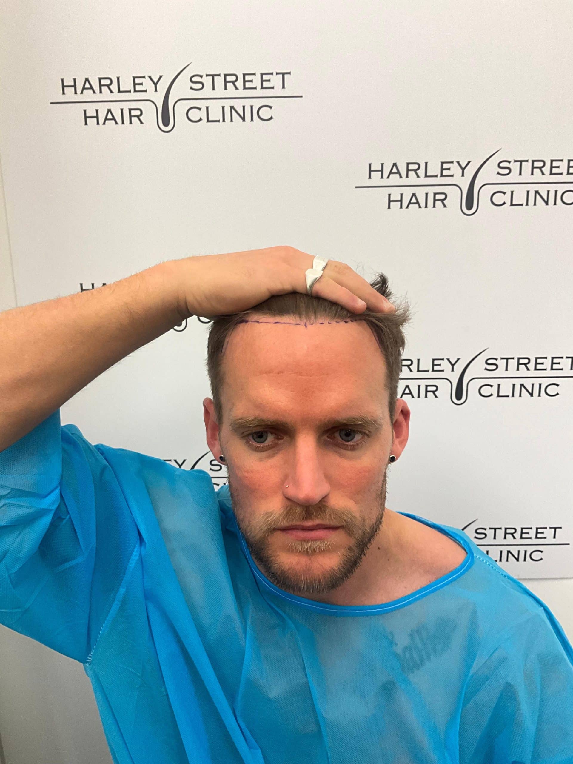 Matt Saillis Before Hair transplant 1