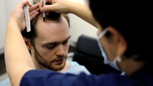 2,000 Graft Hair Transplant