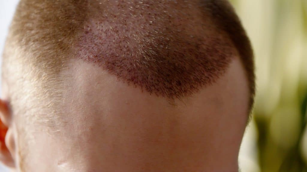 After hair transplant