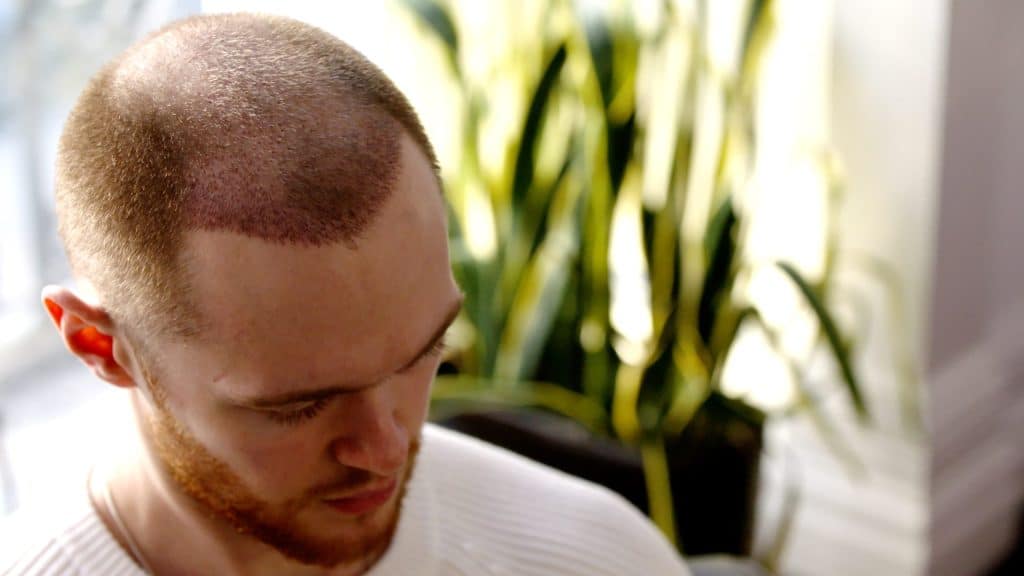 After 2,000 Graft Hair Transplant