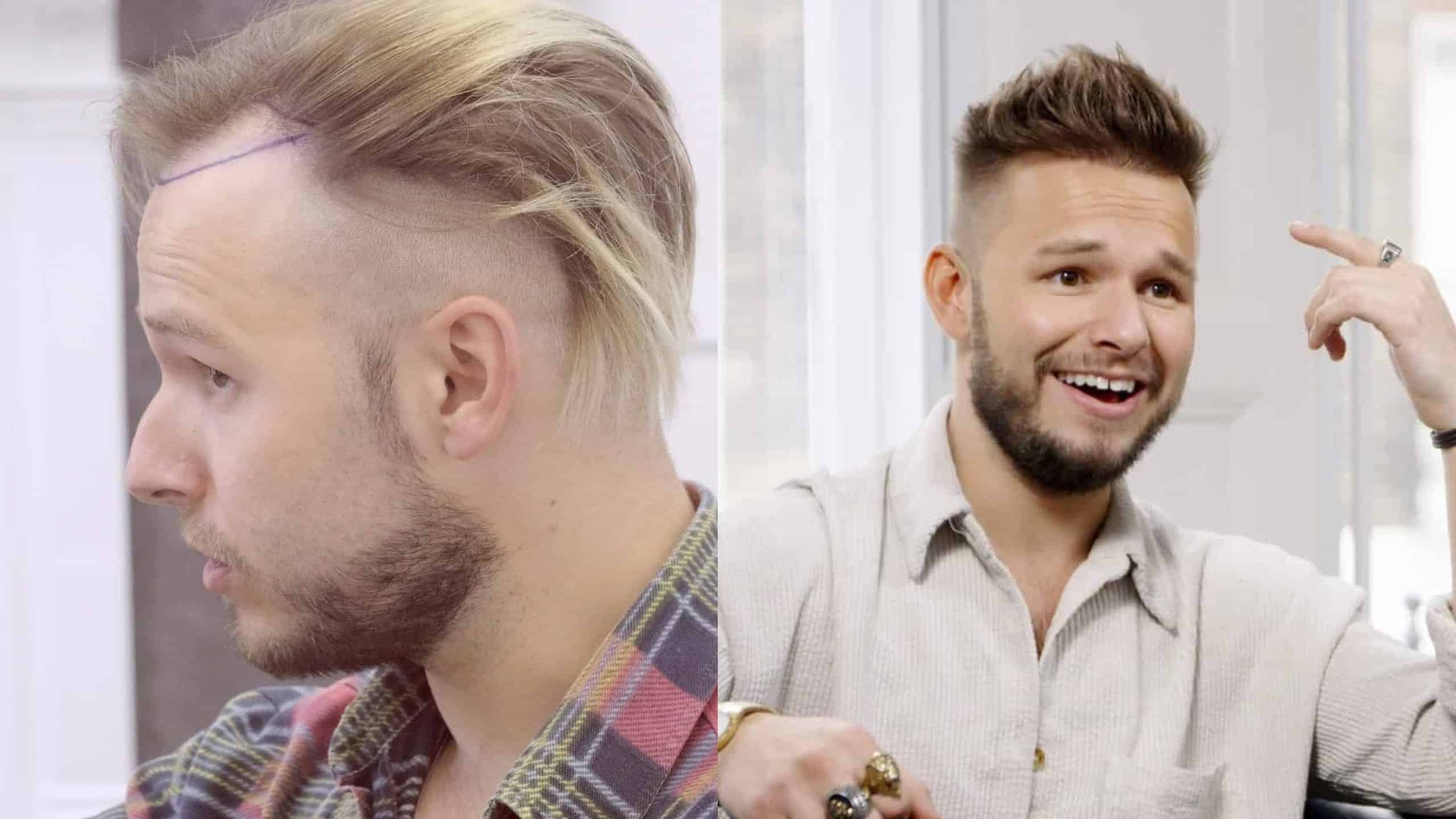 before and after hair transplatation
