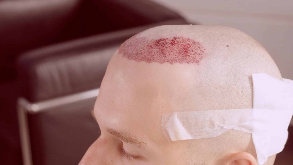 first day of hair transplatation
