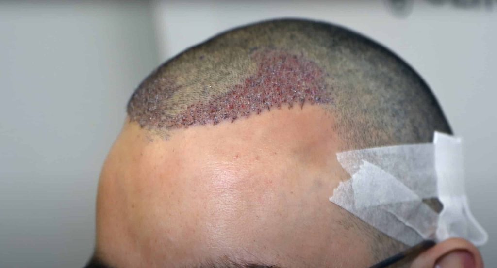 first days after hair transplatation