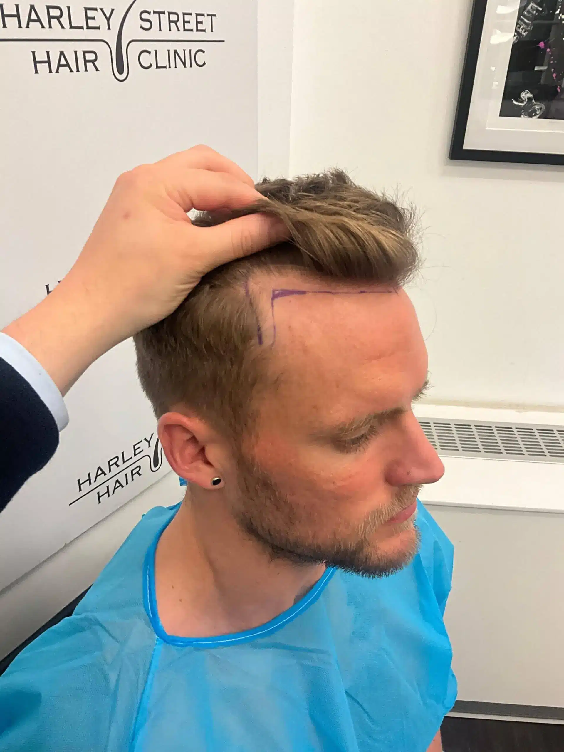 Matt Saillis Before Hair transplant
