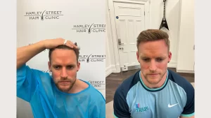 Matt Saillis before and after hair transplant