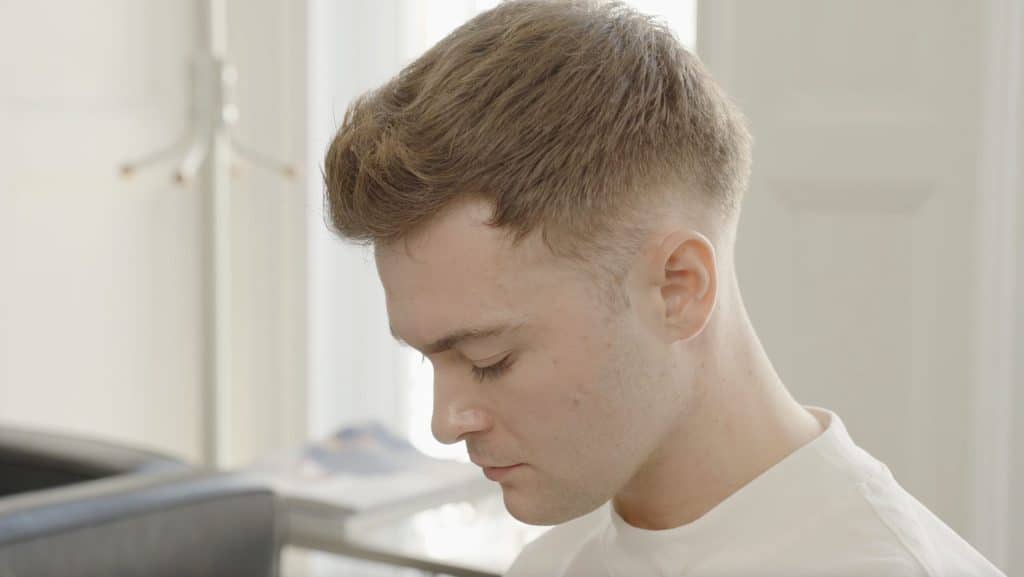 Patient after Minoxidil